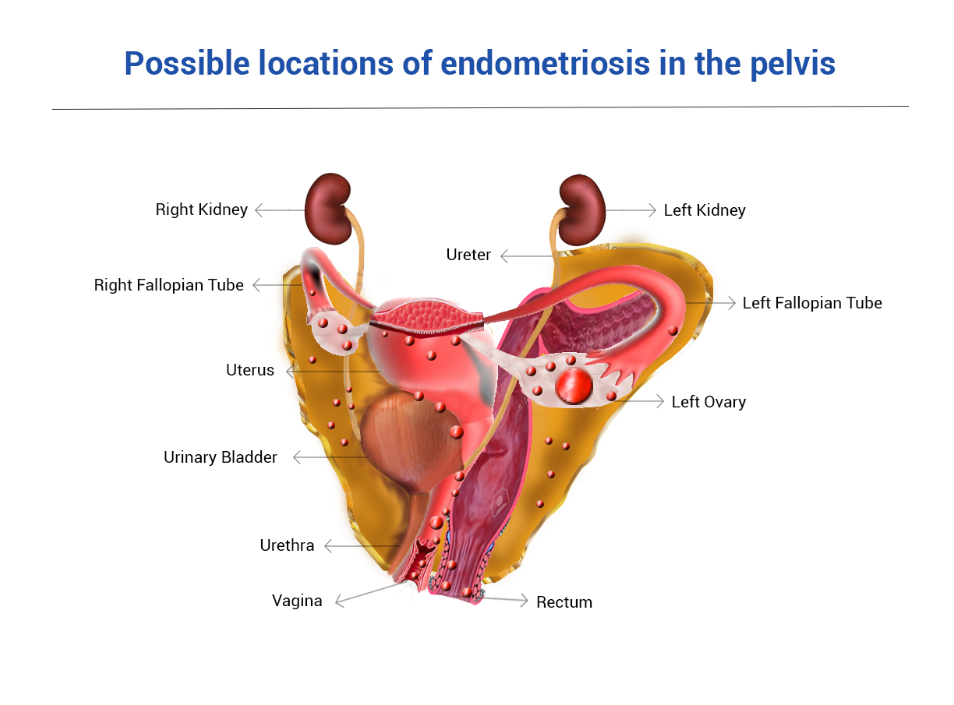 Possible locations of endometriosis in the pelvis