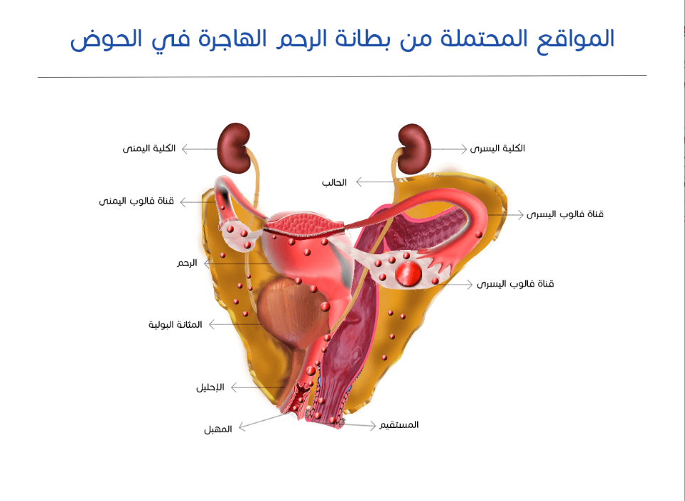 المواقع المحتملة من بطانة الرحم الهاجرة في الحوض